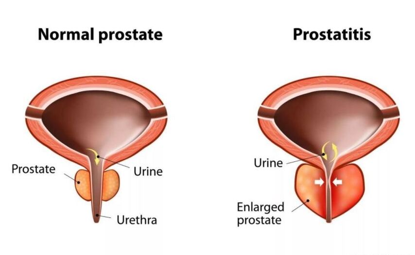 Normal prostat ve iltihaplı