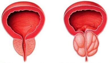 Prostatit ile sağlıklı ve iltihaplı prostat