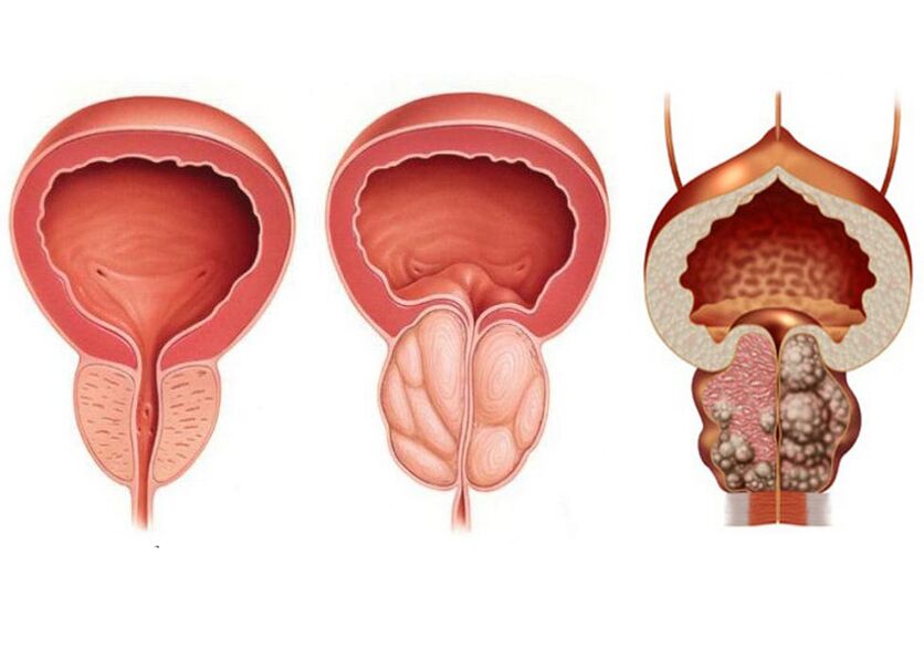 prostatit evreleri ve Prostavit ile tedavi ihtiyacı